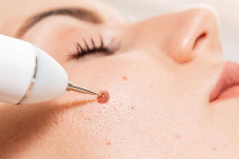 Affordable mole removal in Turkey at top skin clinics – safe, cosmetic mole removal with laser treatment options.