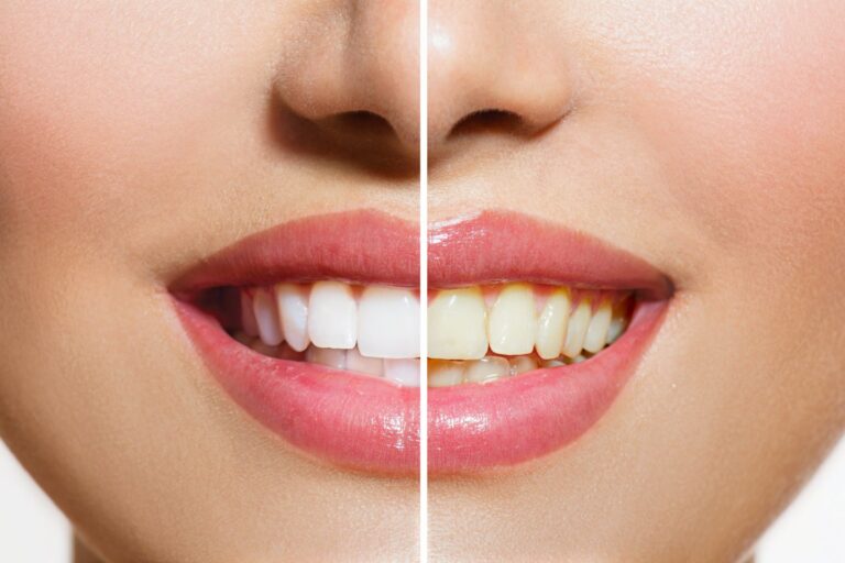 Professional teeth whitening in Turkey for a natural white smile with Aegean Beauty