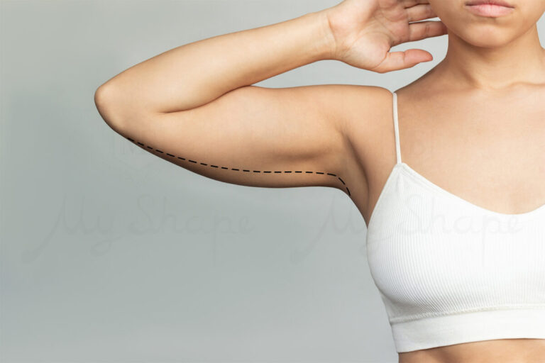Arm Liposuction