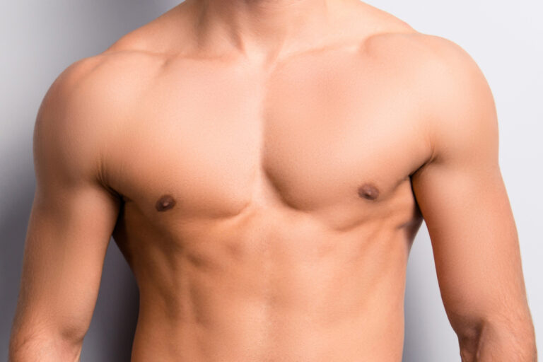 Gynecomastia-MALE